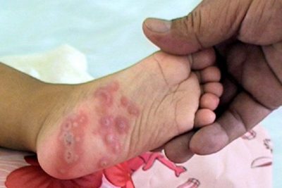 Phòng ngừa và xử lý bệnh tay chân miệng